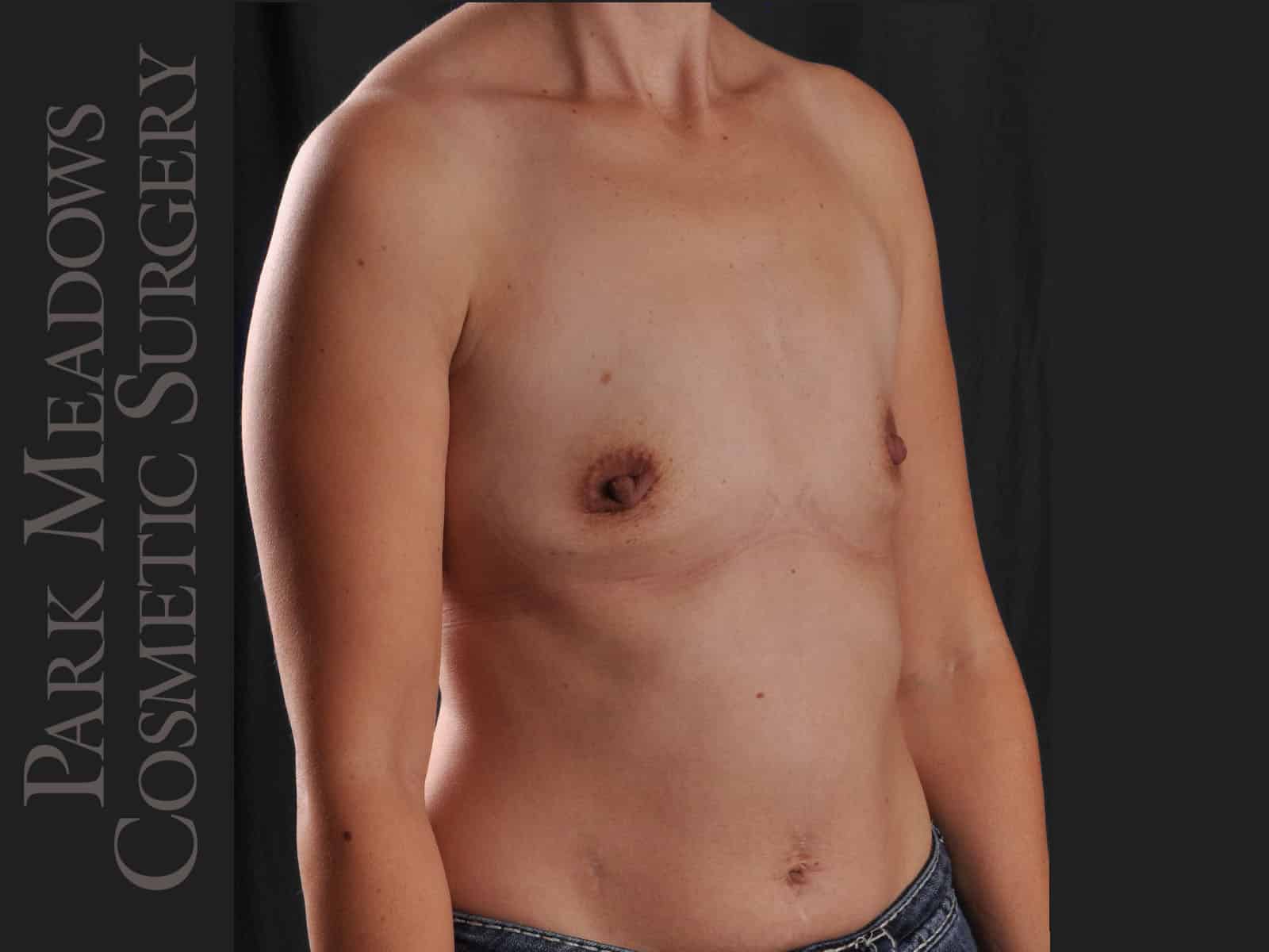 Before Image: Silicone Breast Augmentation - right-front-oblique