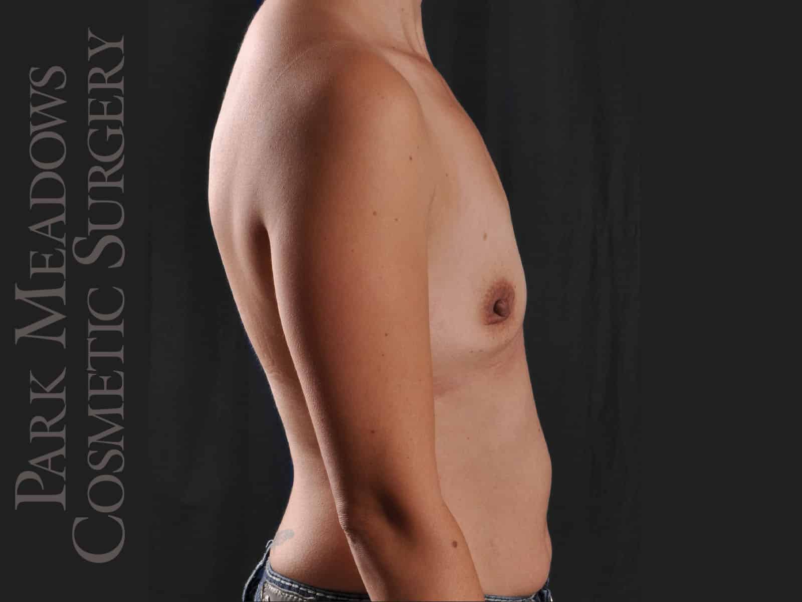 Before Image: Silicone Breast Augmentation - right-side