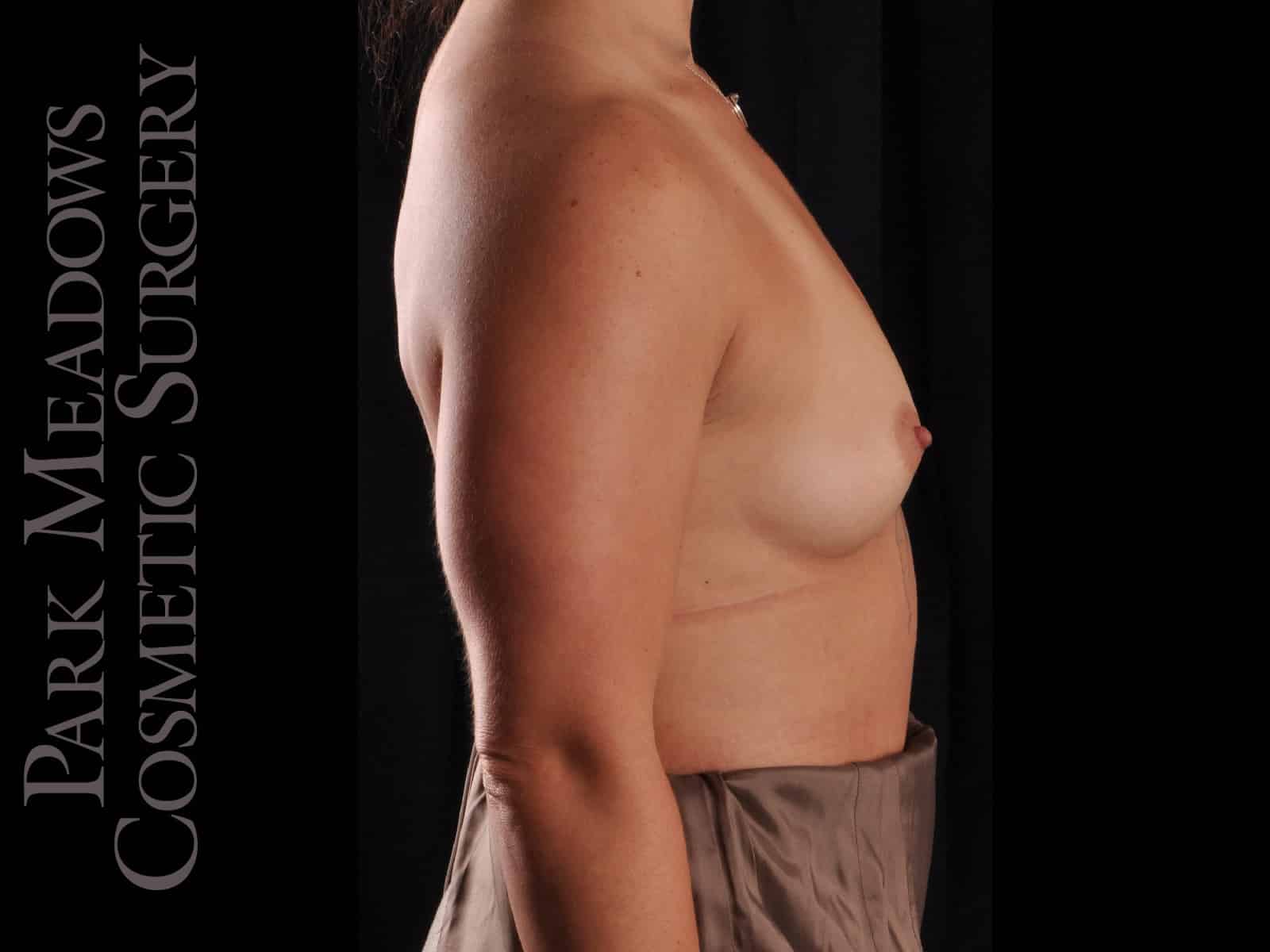 Before Image: Silicone Breast Augmentation - right-side