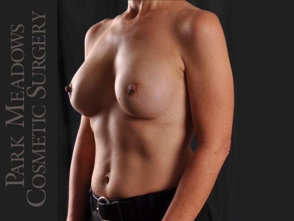 After Image: Silicone Breast Augmentation - left-front-oblique