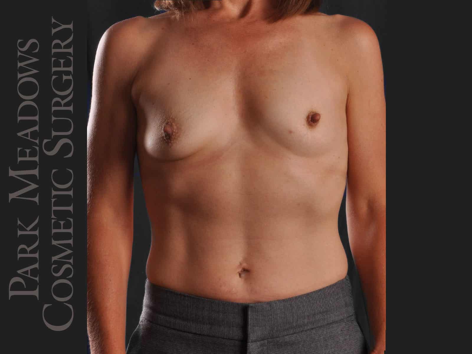 Before Image: Silicone Breast Augmentation - front