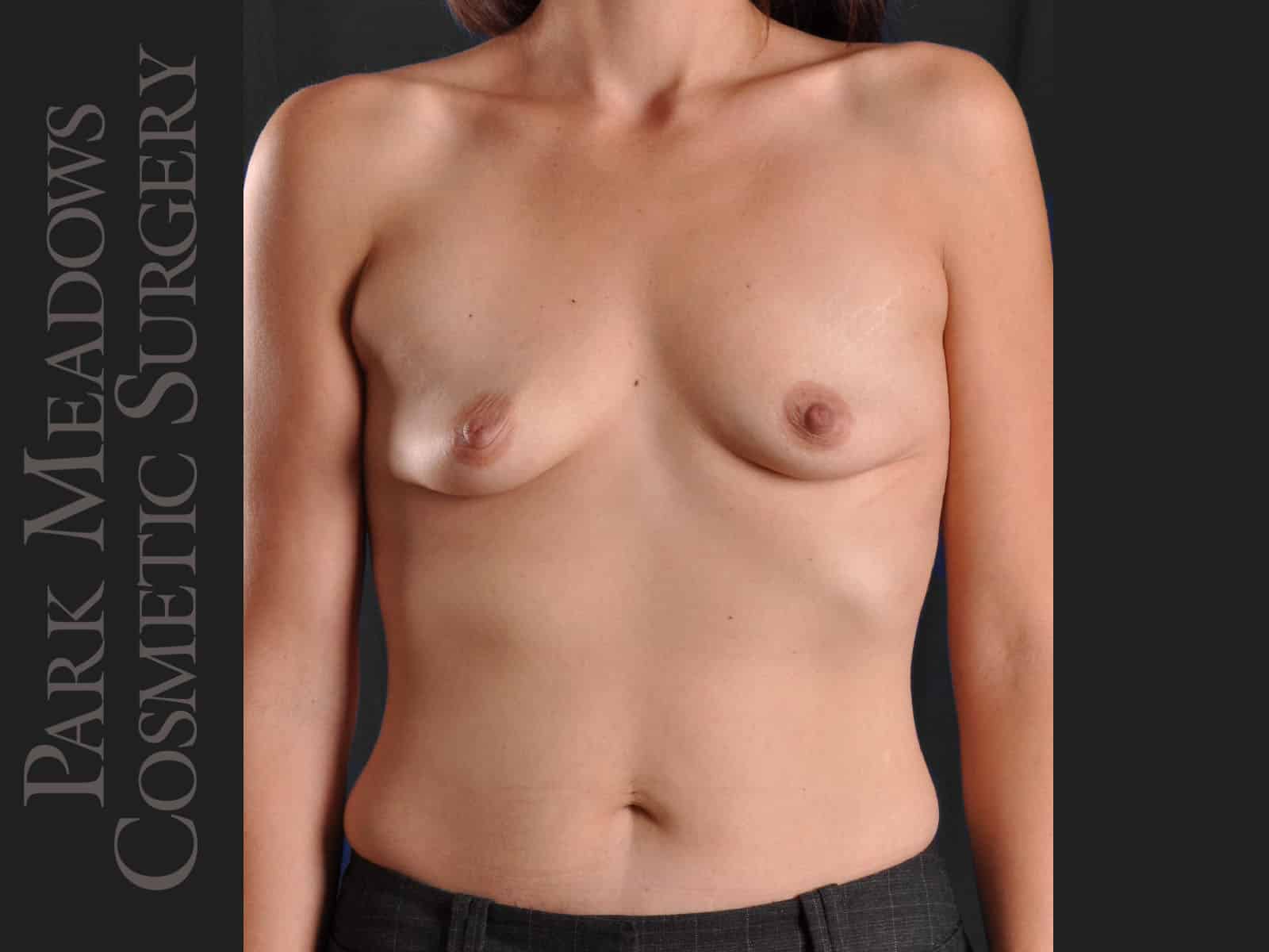 Before Image: Silicone Breast Augmentation - front