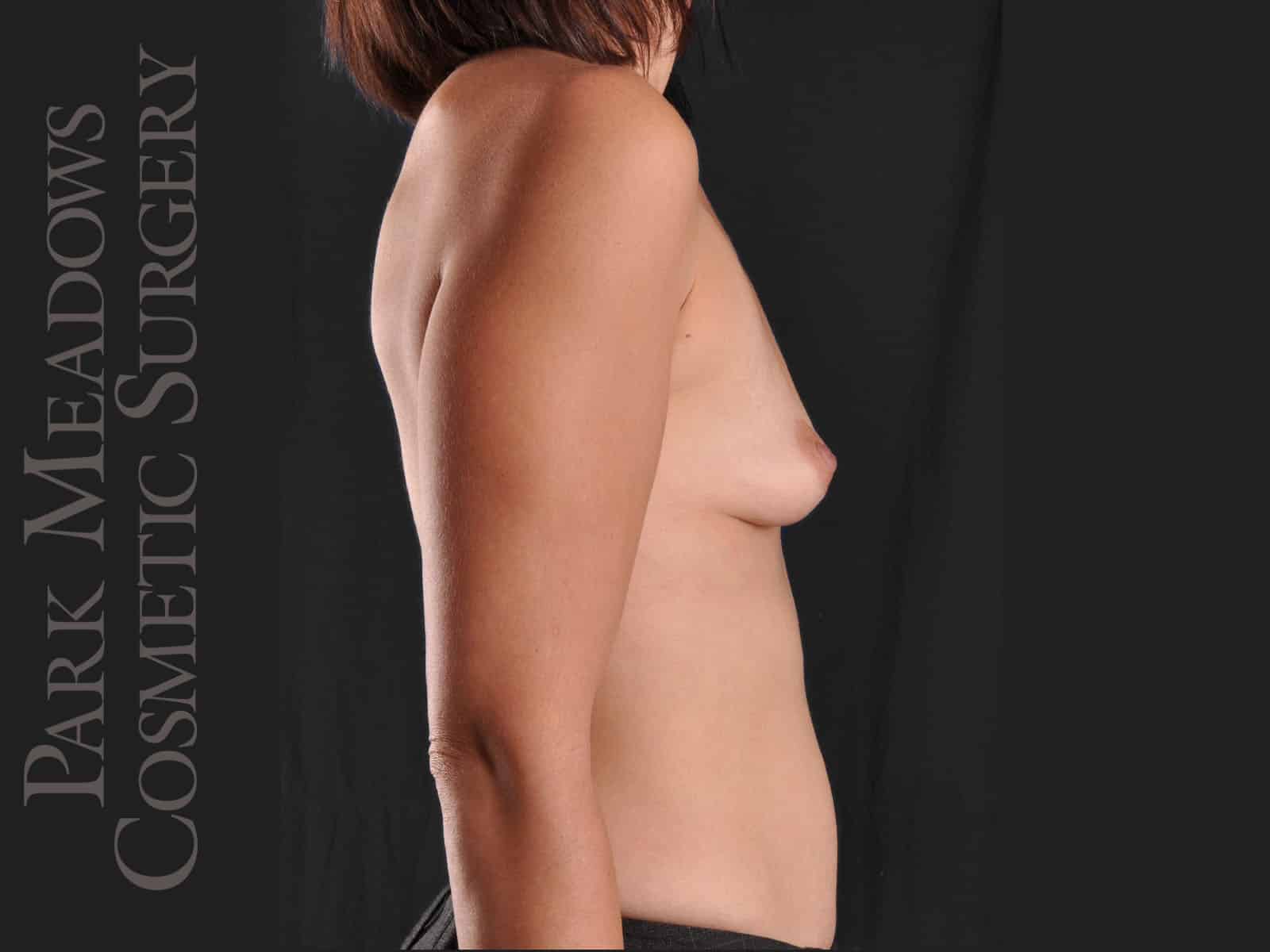 Before Image: Silicone Breast Augmentation - right-side