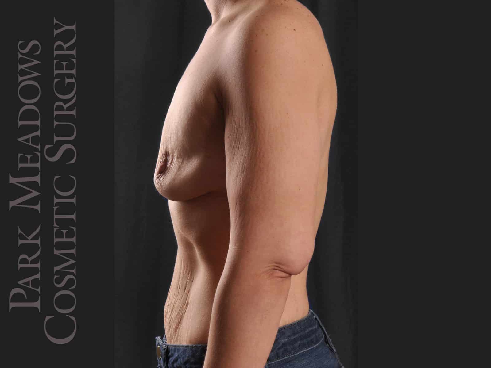 Before Image: Silicone Breast Augmentation - left-side
