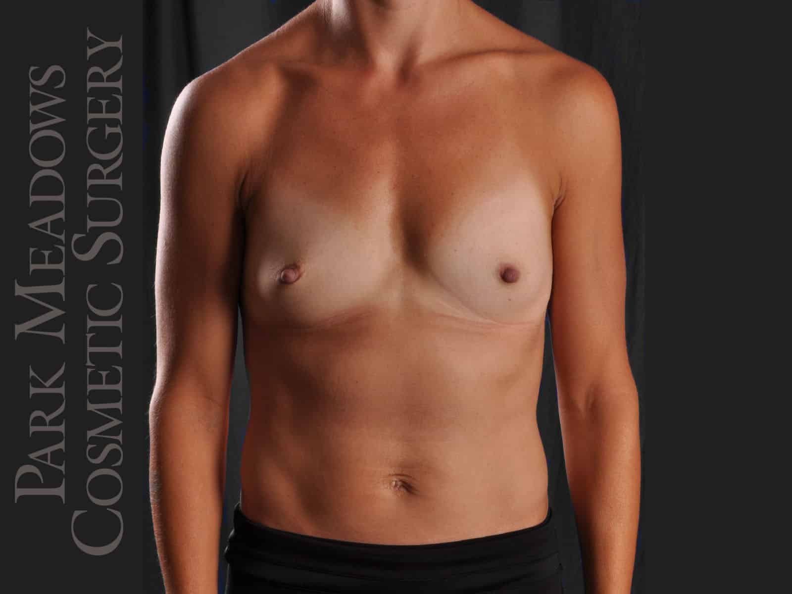 Before Image: Silicone Breast Augmentation - front