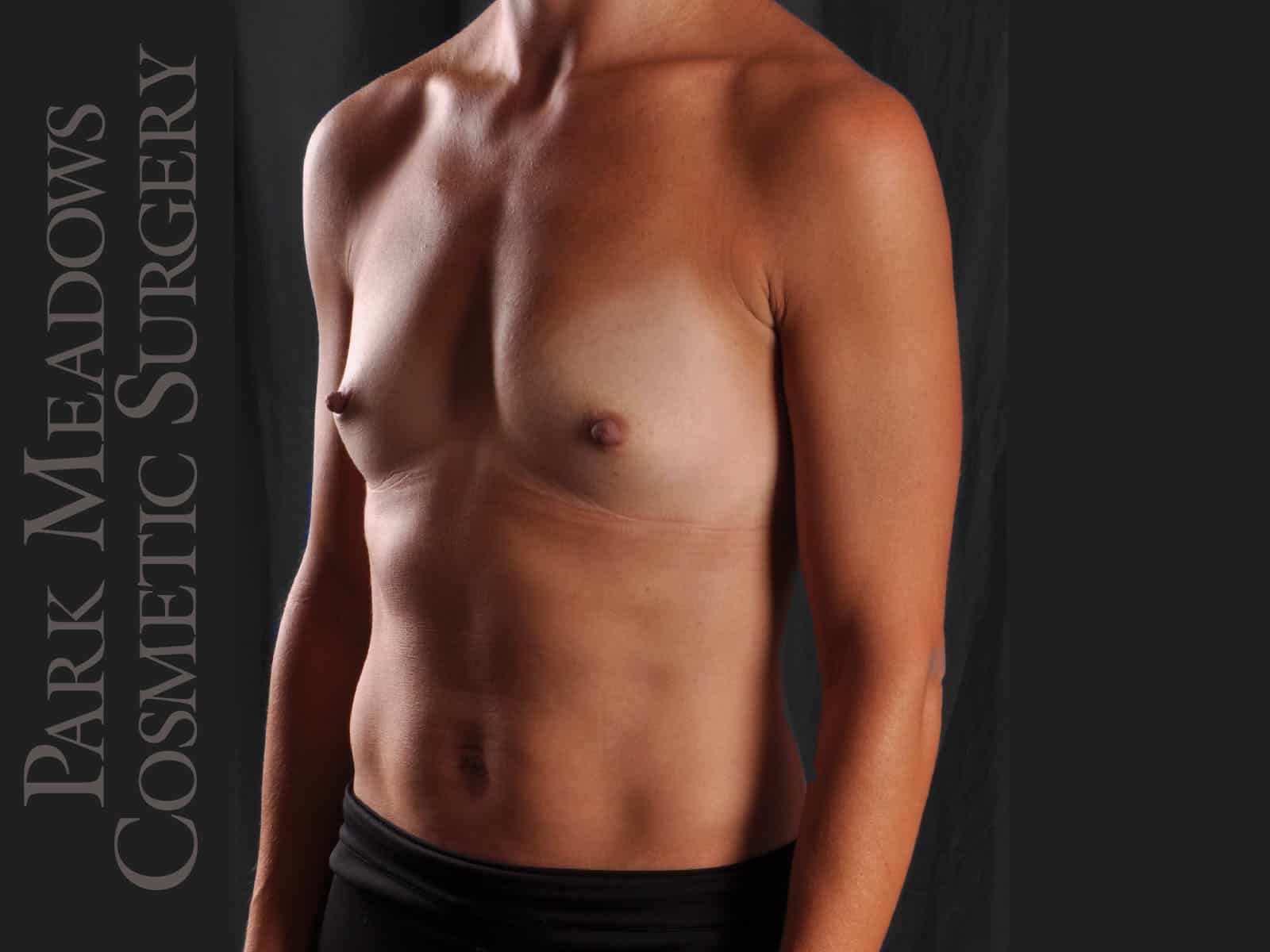Before Image: Silicone Breast Augmentation - left-front-oblique