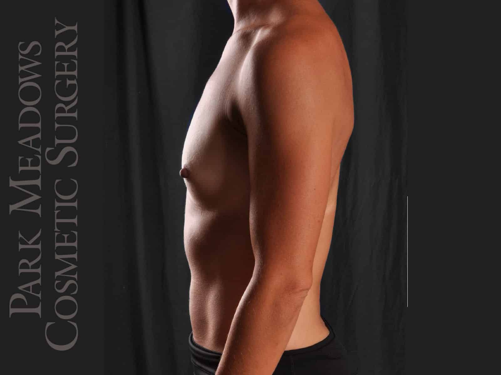 Before Image: Silicone Breast Augmentation - left-side