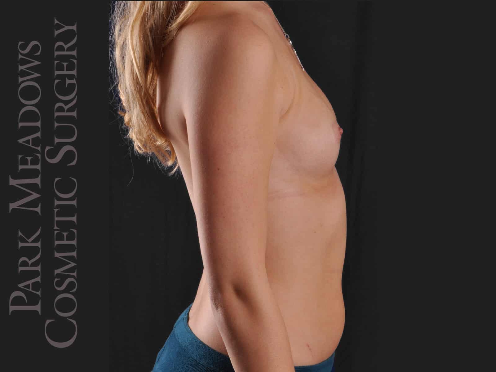 Before Image: Silicone Breast Augmentation - right-side