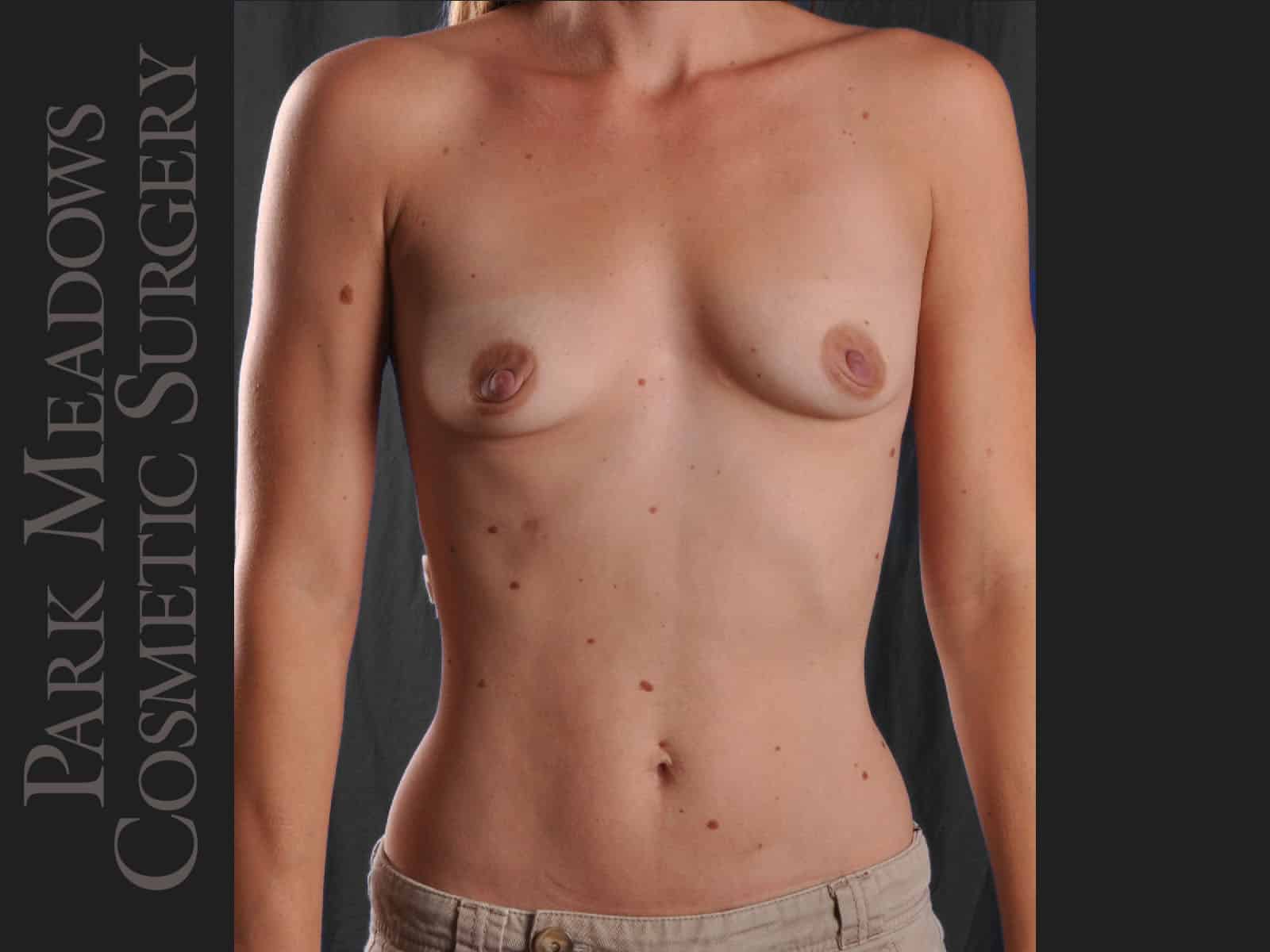 Before Image: Silicone Breast Augmentation - front