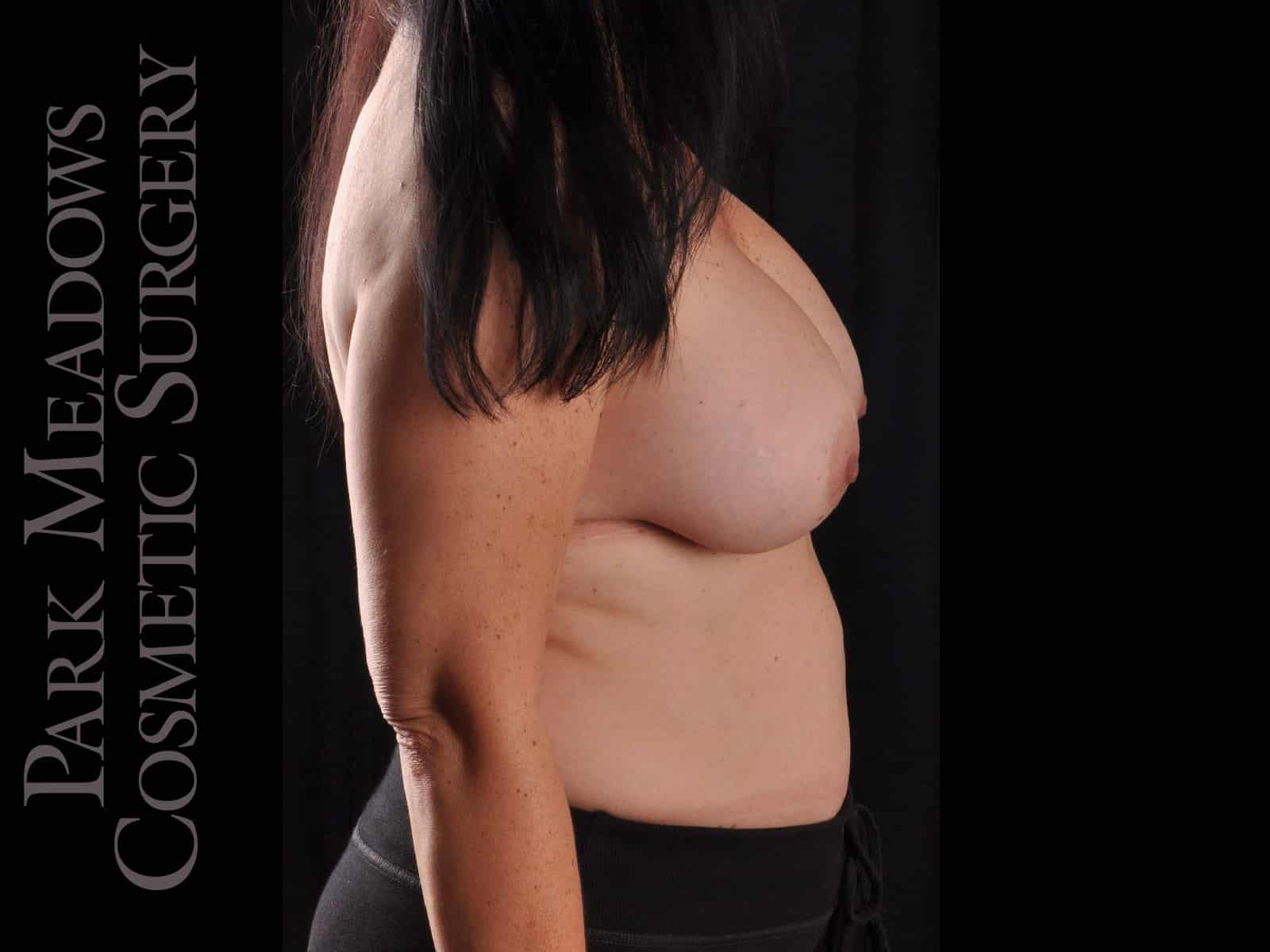 After Image: Silicone Breast Augmentation - right-side