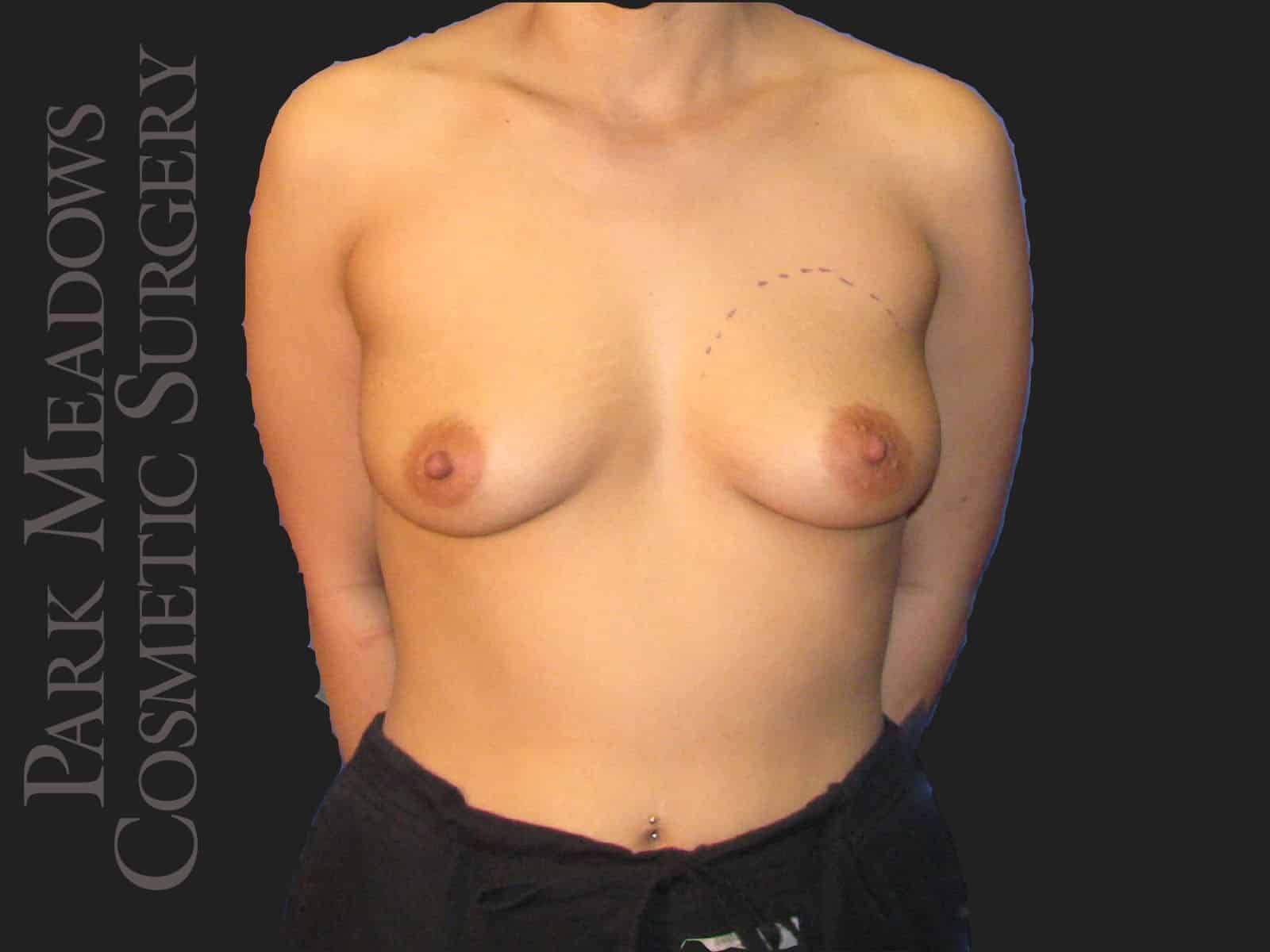 Before Image: Silicone Breast Augmentation - front