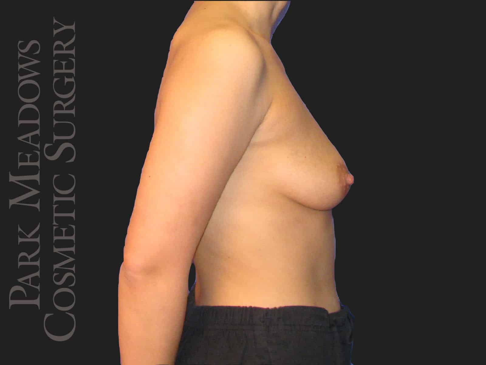 Before Image: Silicone Breast Augmentation - right-side