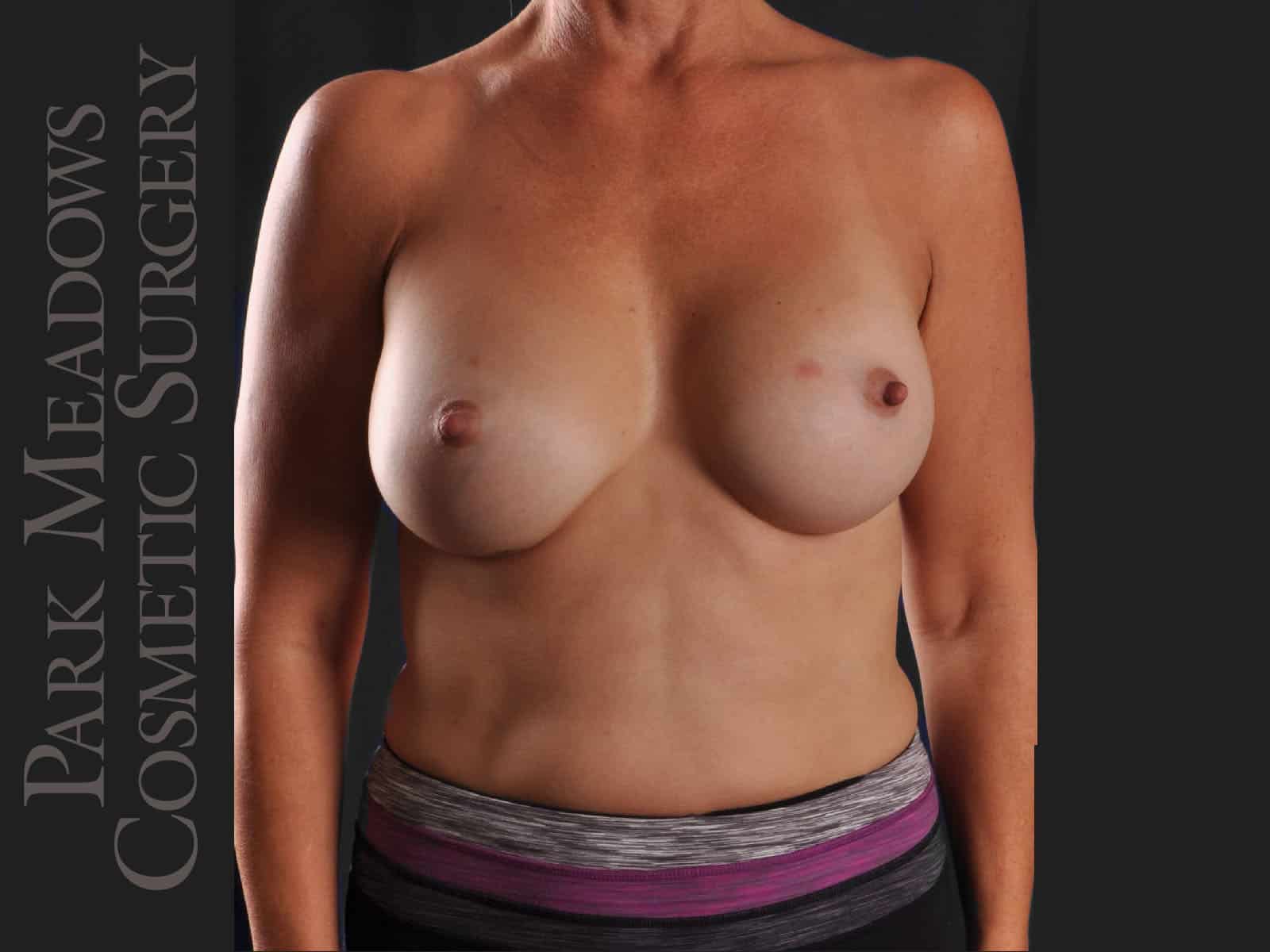 After Image: Silicone Breast Augmentation - front