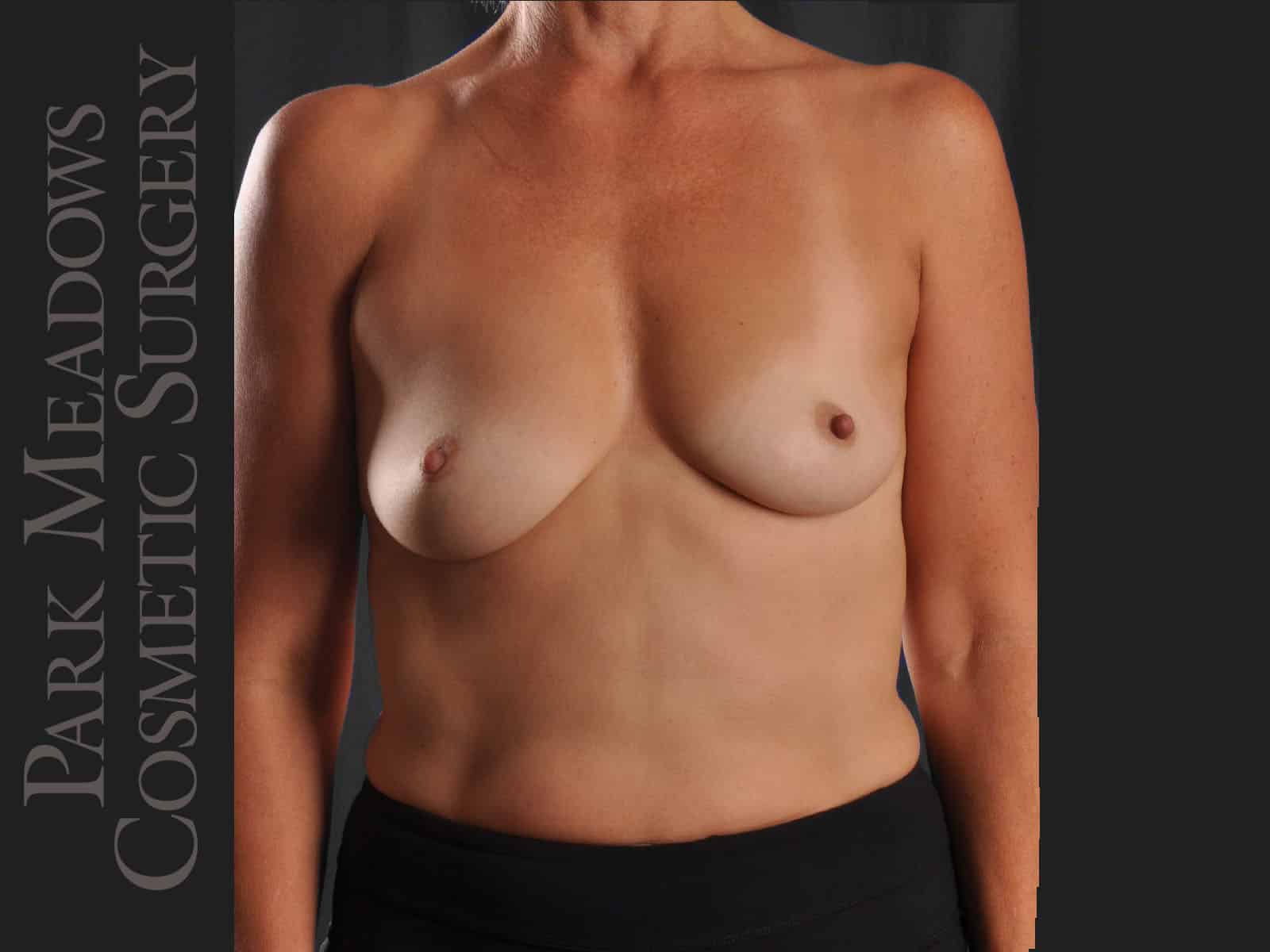 Before Image: Silicone Breast Augmentation - front