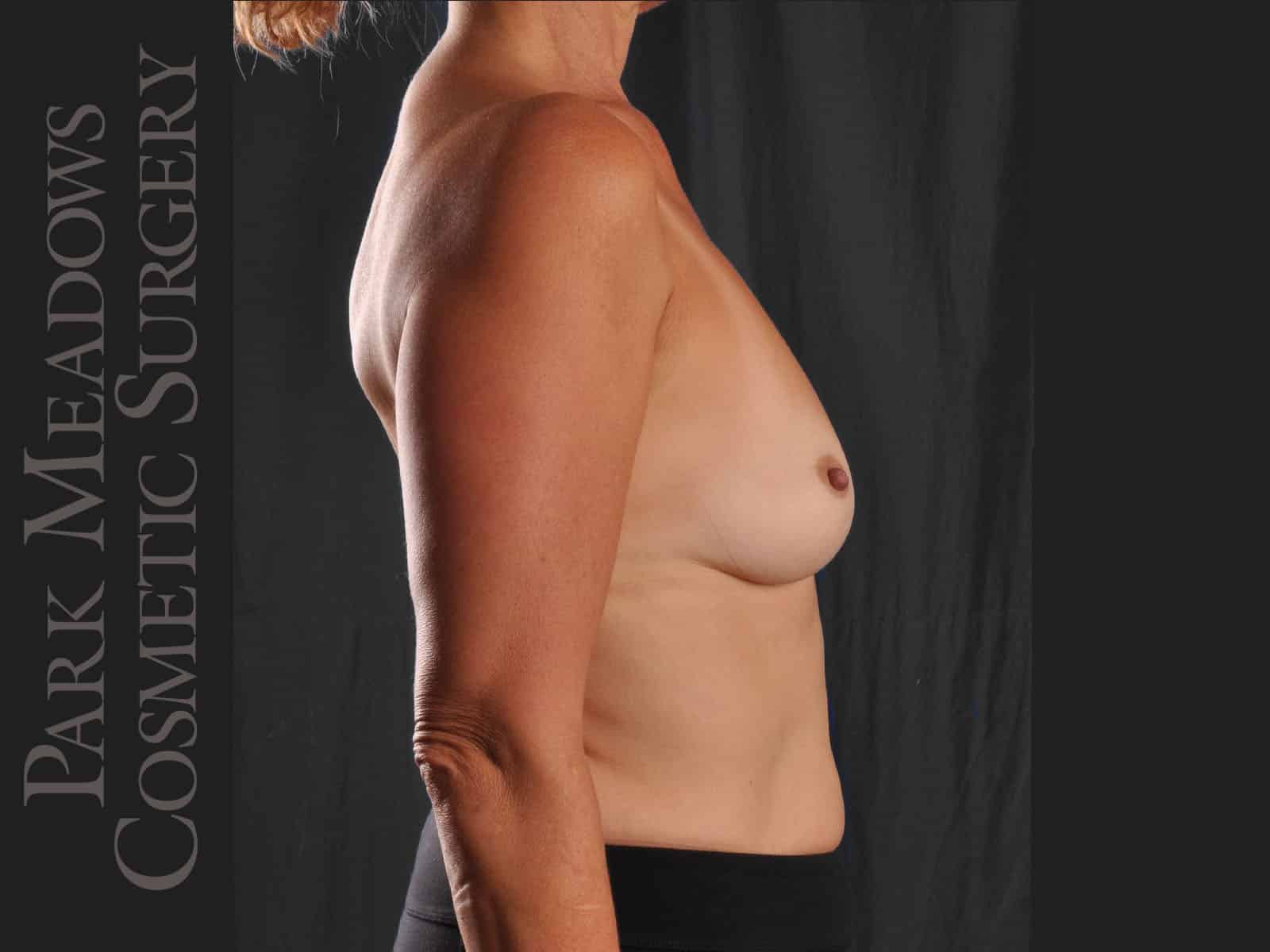 Before Image: Silicone Breast Augmentation - right-side
