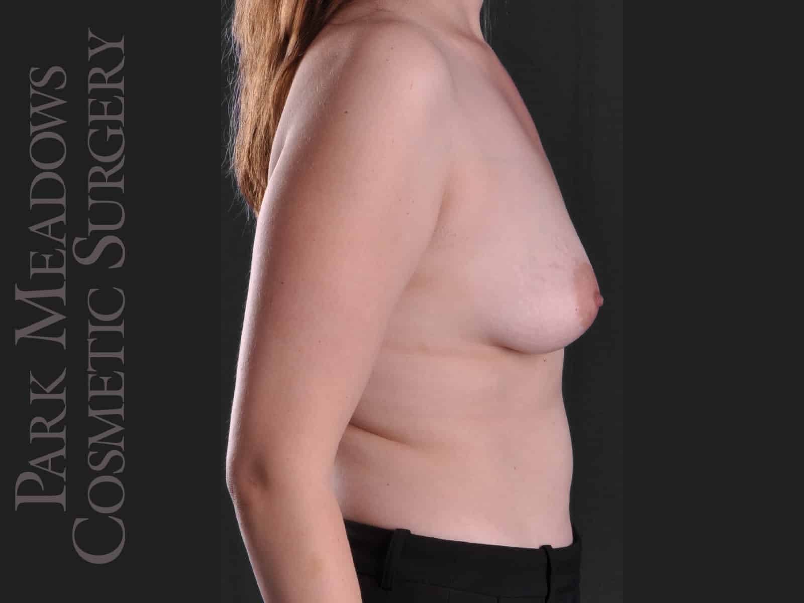 Before Image: Silicone Breast Augmentation - right-side