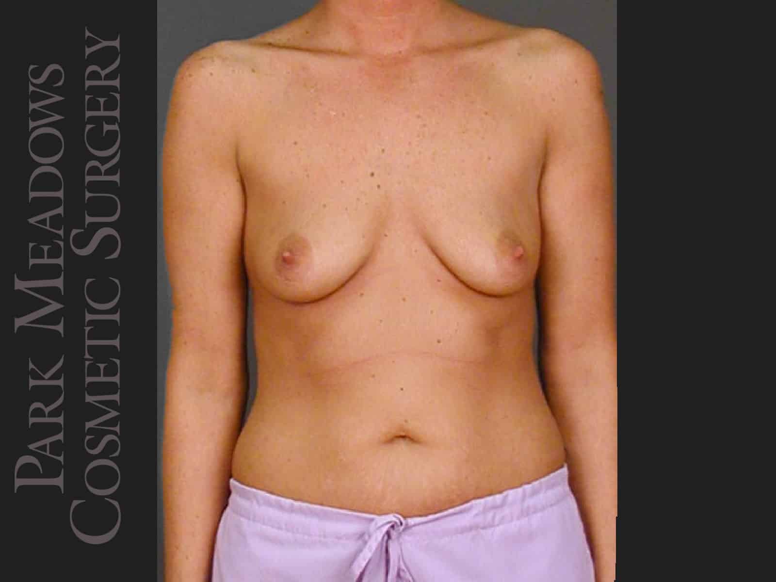 Before Image: Silicone Breast Augmentation - front
