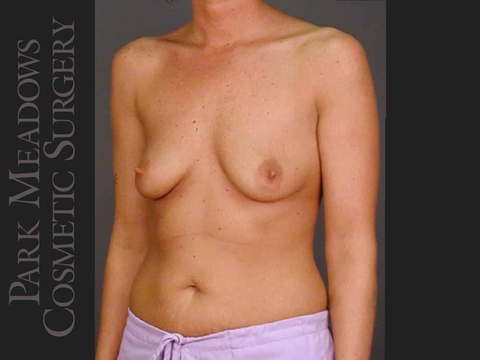 Before Image: Silicone Breast Augmentation - left-front-oblique