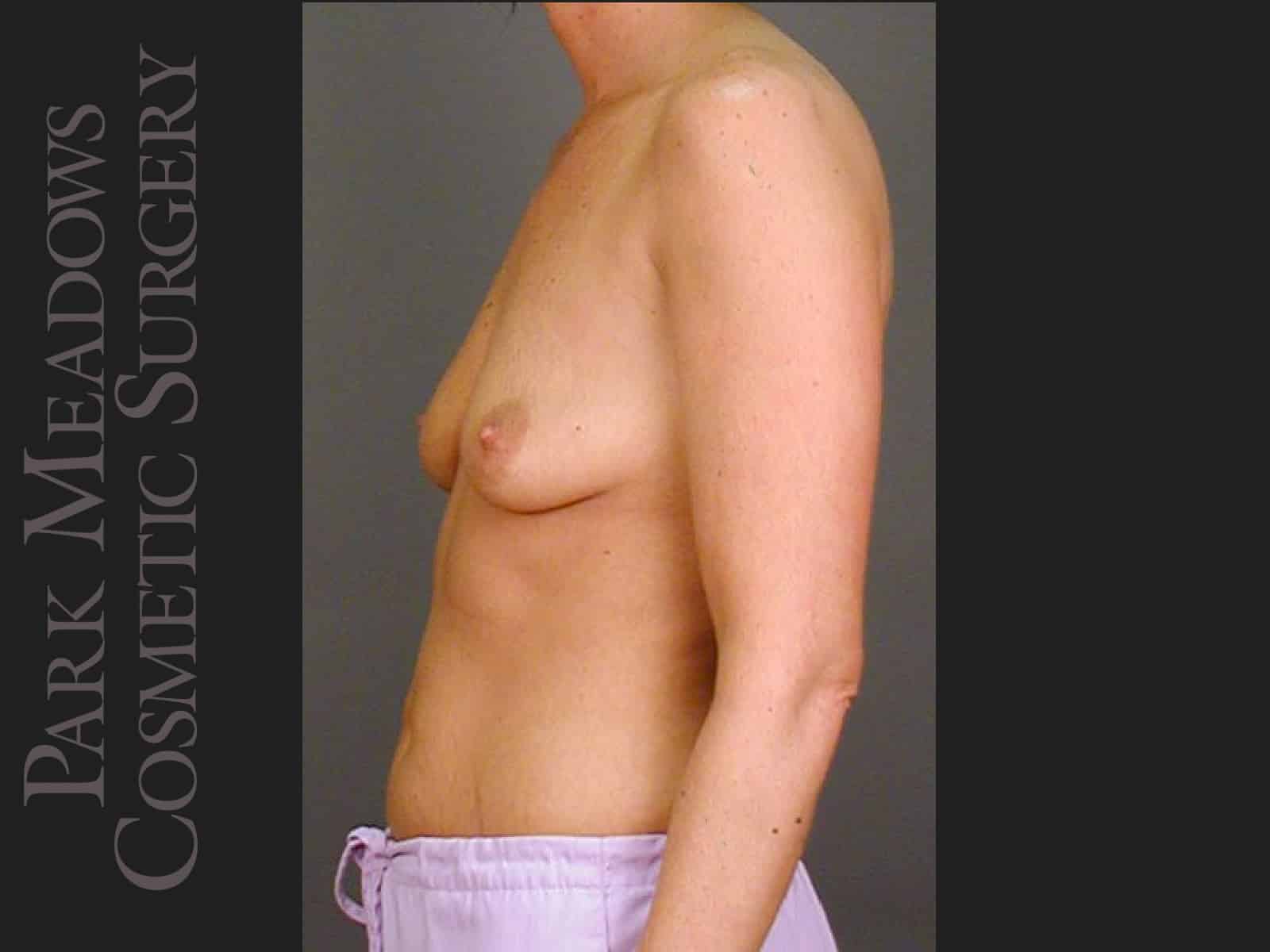 Before Image: Silicone Breast Augmentation - left-side