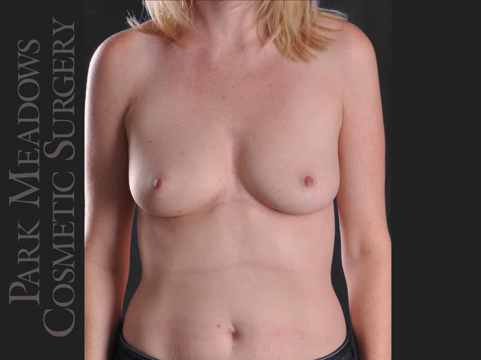 Before Image: Silicone Breast Augmentation - front
