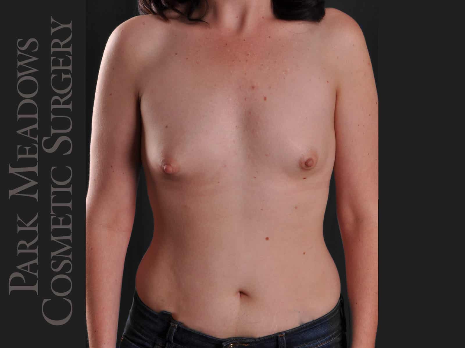 Before Image: Silicone Breast Augmentation - front