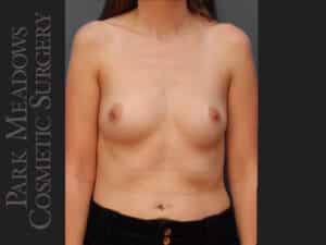 Silicone Breast Augmentation