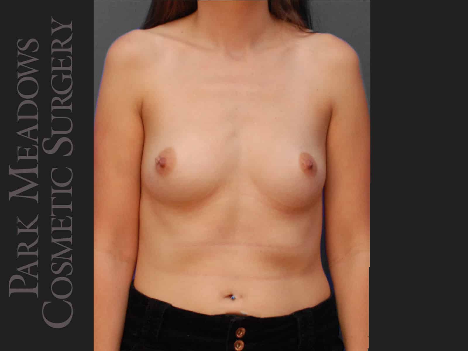 Before Image: Silicone Breast Augmentation - front