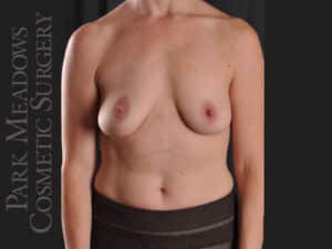 Silicone Breast Augmentation
