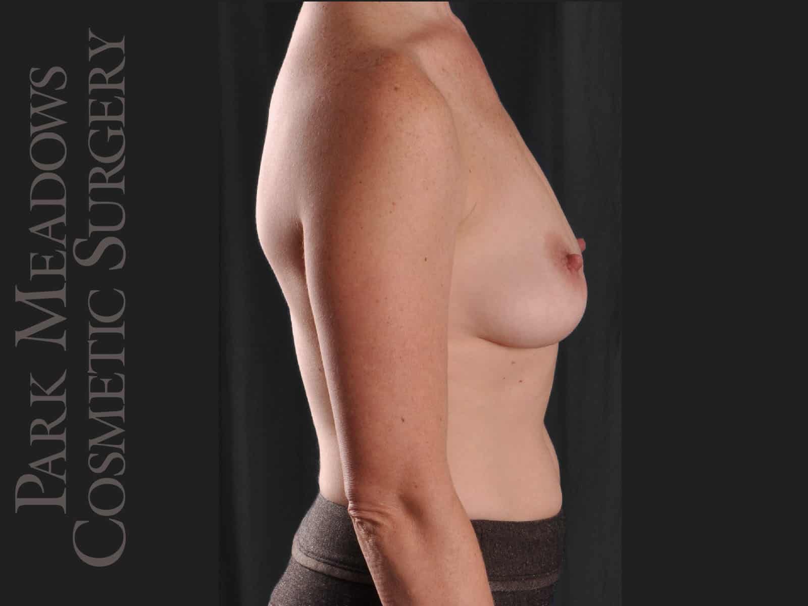 Before Image: Silicone Breast Augmentation - right-side