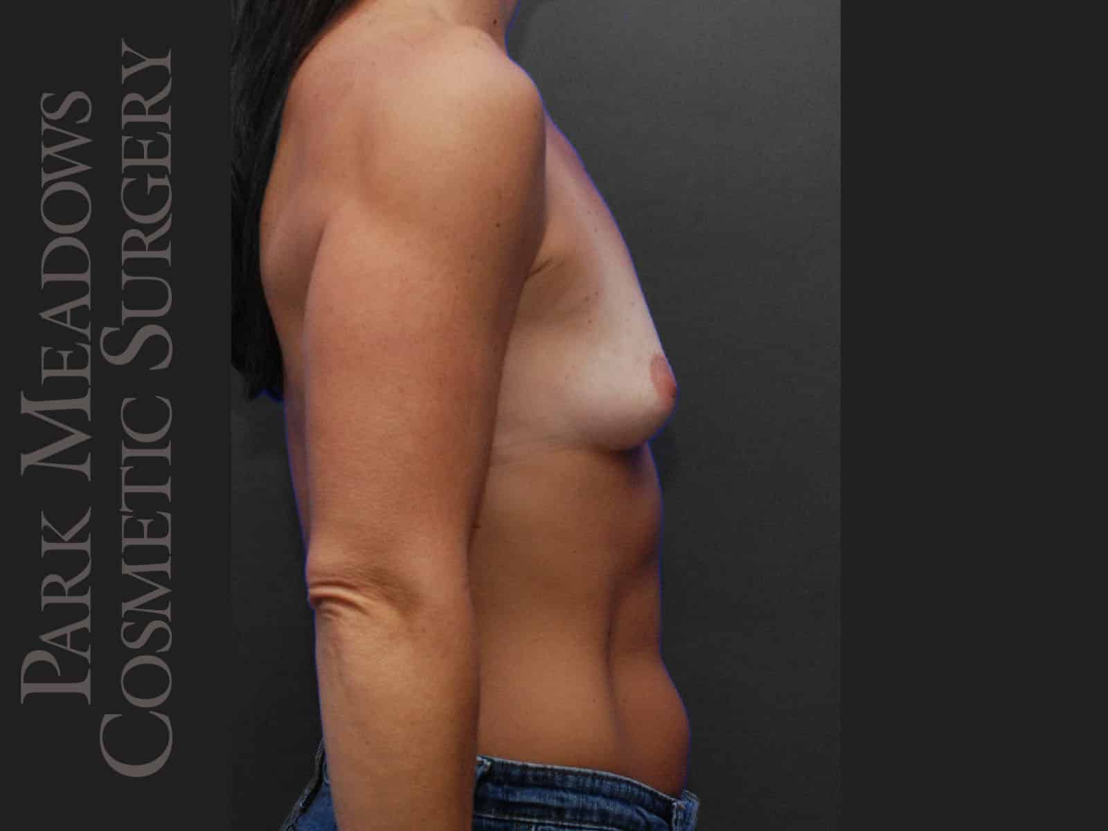 Before Image: Silicone Breast Augmentation - right-side
