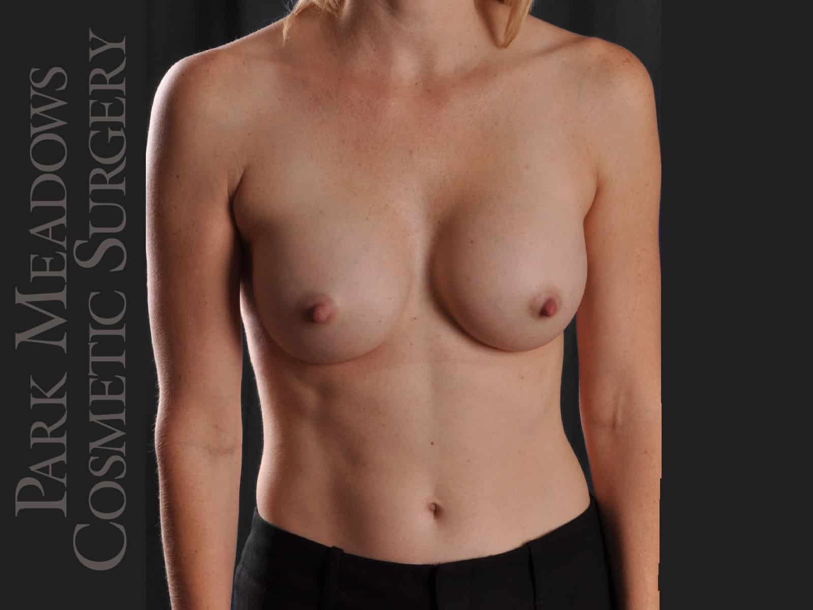 After Image: Silicone Breast Augmentation - front