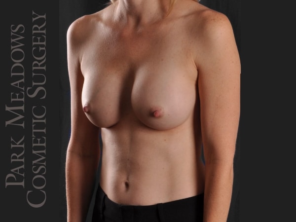 After Image: Silicone Breast Augmentation - left-front-oblique