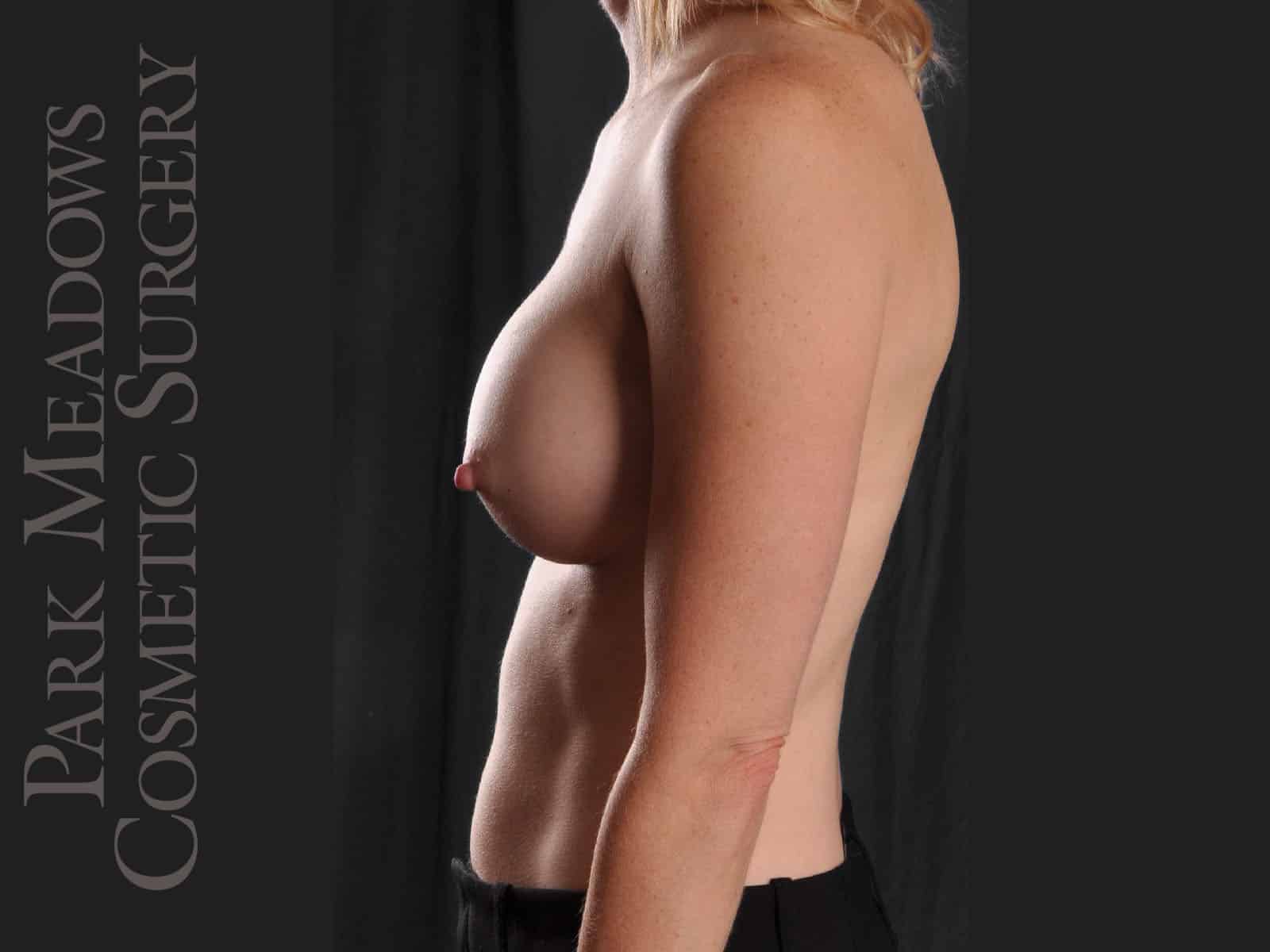 After Image: Silicone Breast Augmentation - left-side