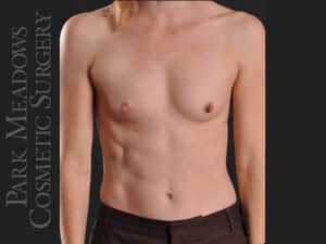 Silicone Breast Augmentation