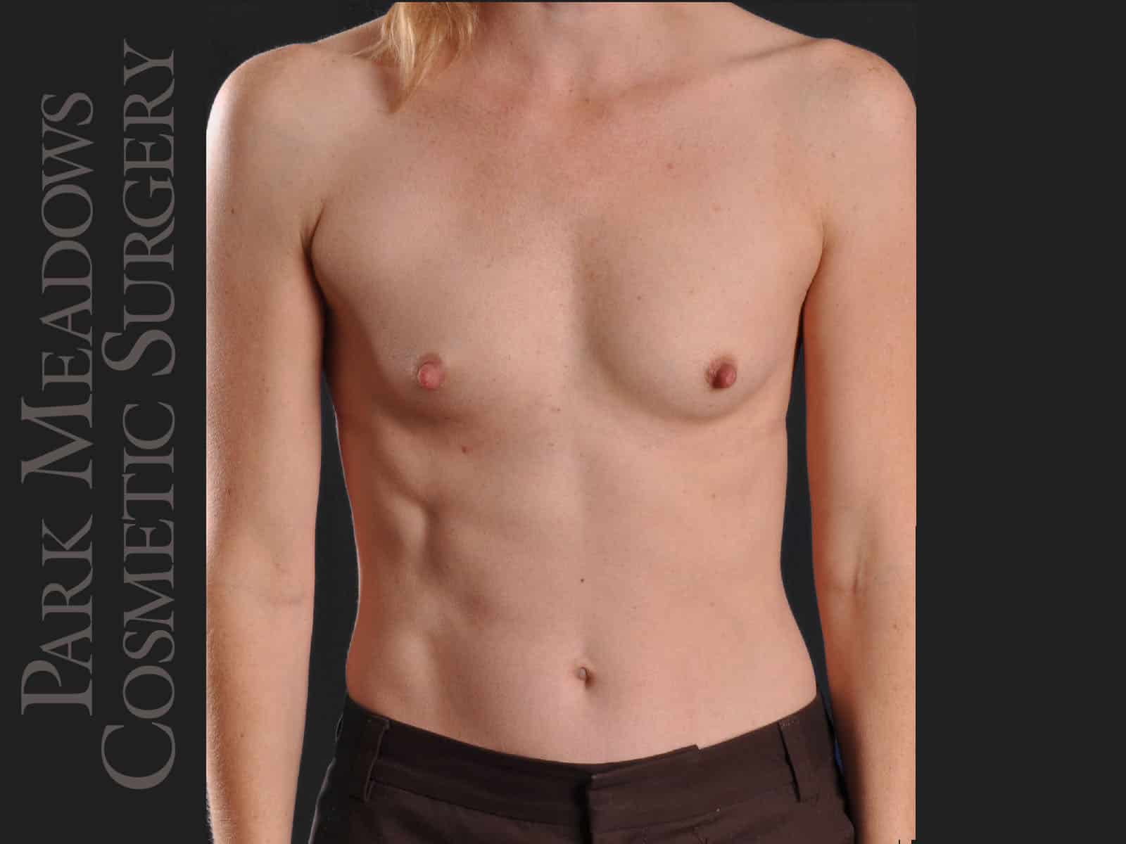 Before Image: Silicone Breast Augmentation - front