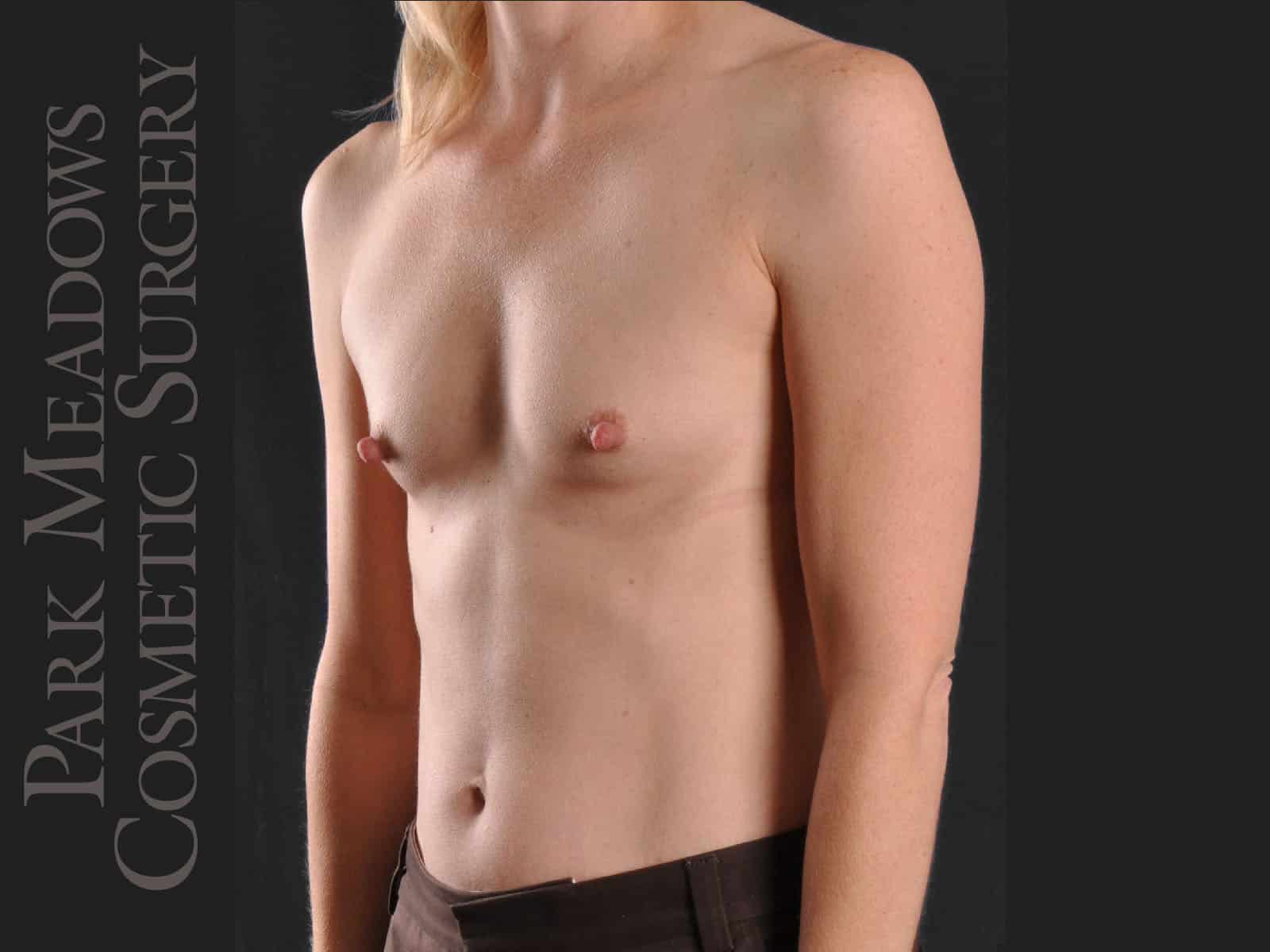 Before Image: Silicone Breast Augmentation - left-front-oblique