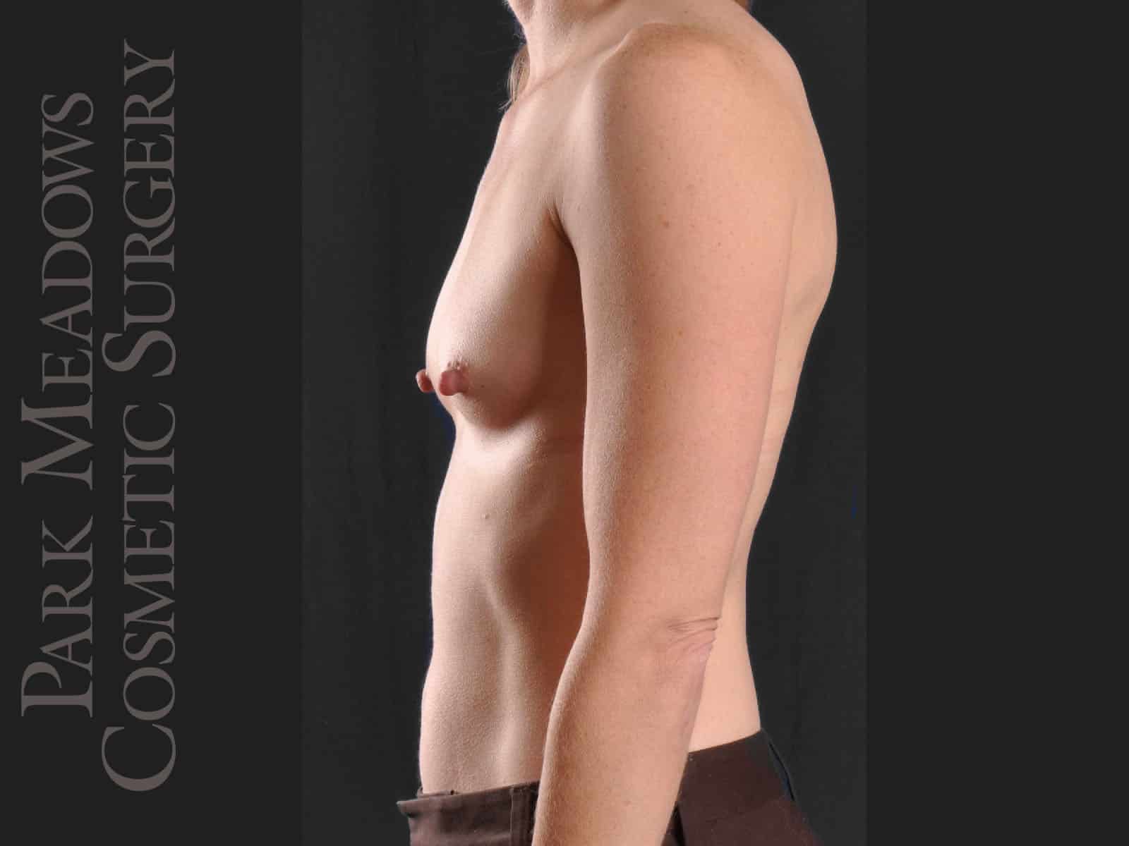 Before Image: Silicone Breast Augmentation - left-side
