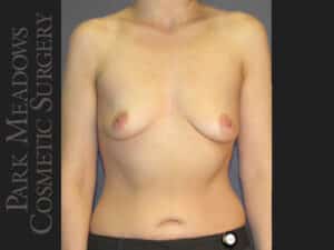 Silicone Breast Augmentation