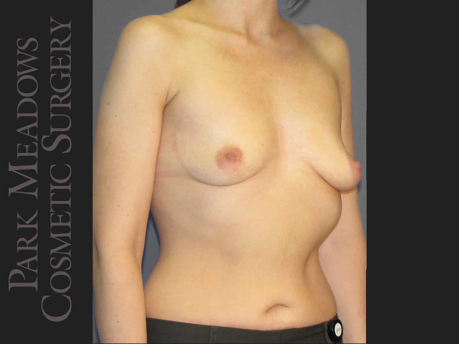 Before Image: Silicone Breast Augmentation - right-front-oblique