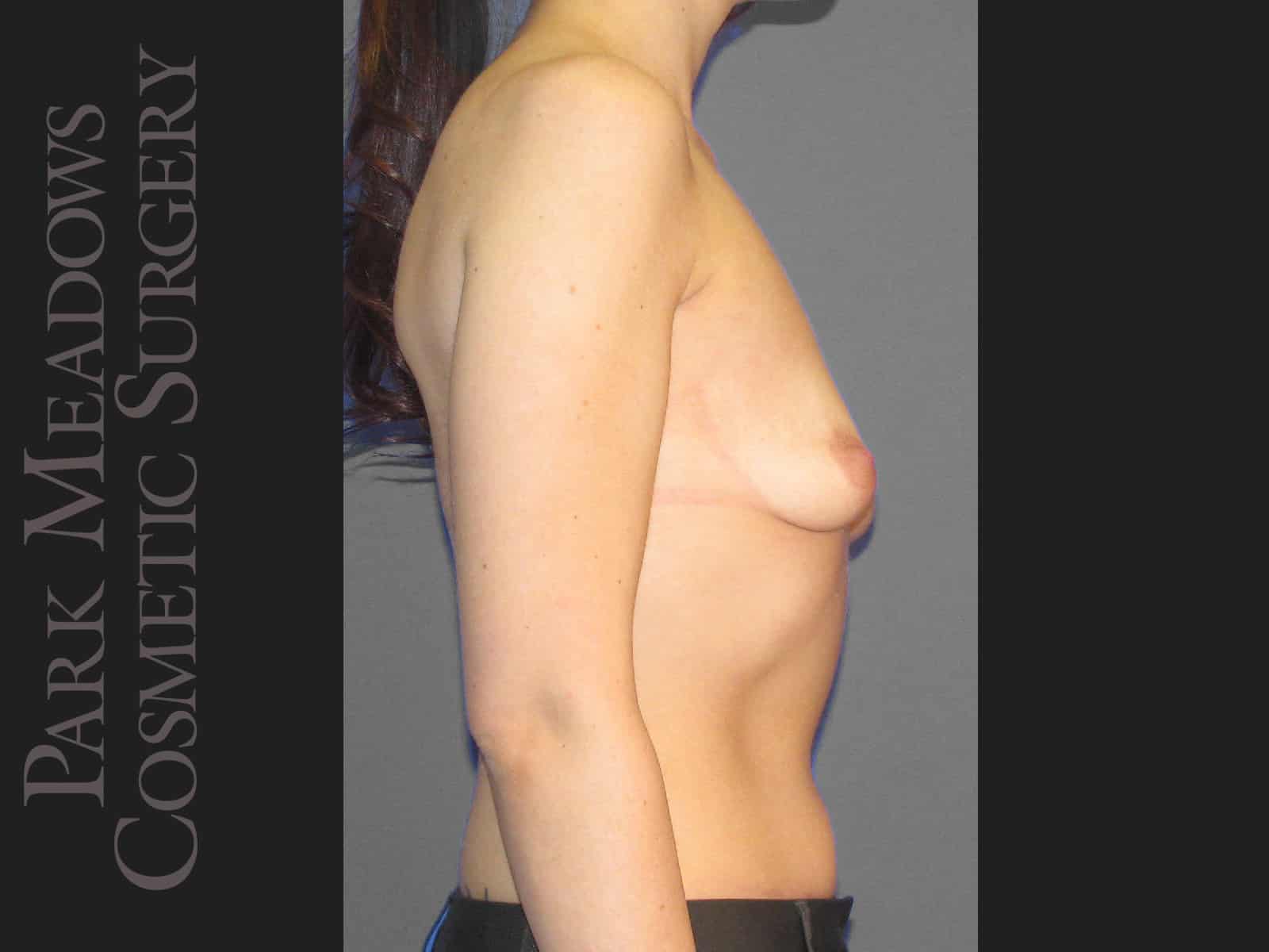 Before Image: Silicone Breast Augmentation - right-side