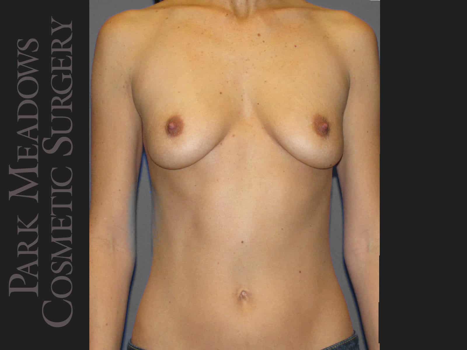 Before Image: Silicone Breast Augmentation - front