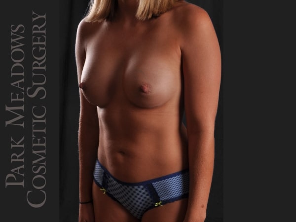 After Image: Silicone Breast Augmentation - left-front-oblique