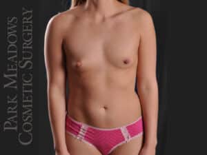 Silicone Breast Augmentation