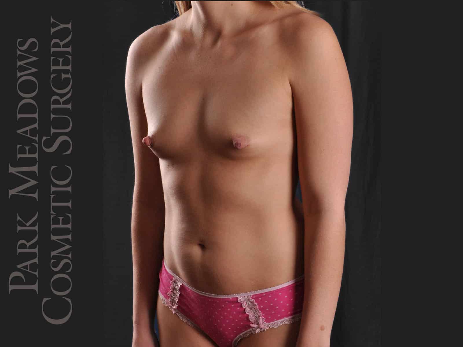 Before Image: Silicone Breast Augmentation - left-front-oblique
