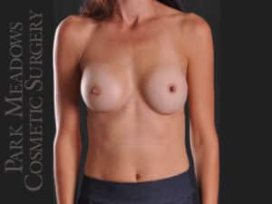 Silicone Breast Augmentation