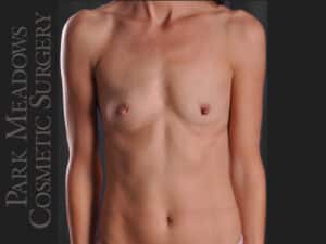 Silicone Breast Augmentation