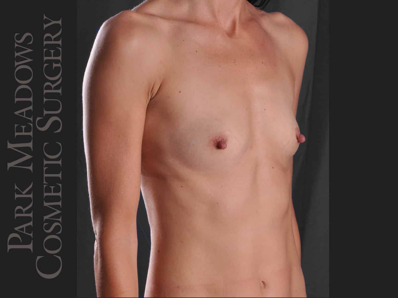 Before Image: Silicone Breast Augmentation - right-front-oblique