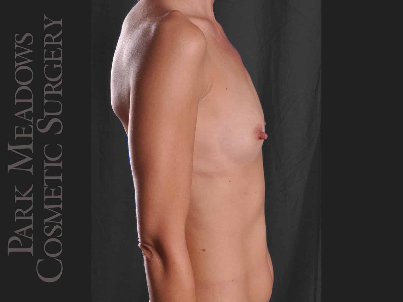 Before Image: Silicone Breast Augmentation - right-side