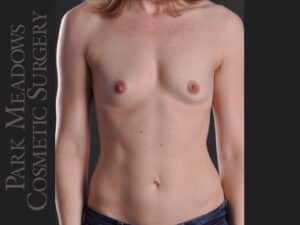 Silicone Breast Augmentation