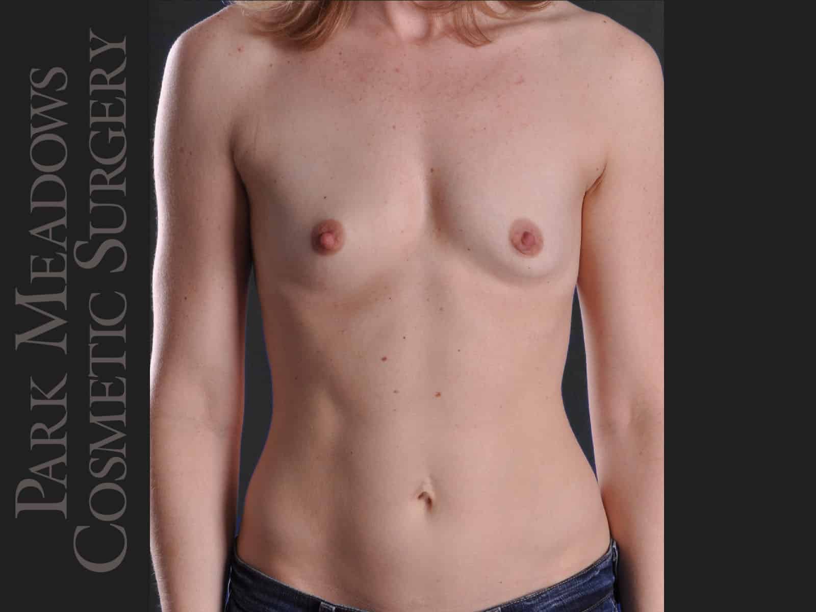 Before Image: Silicone Breast Augmentation - front